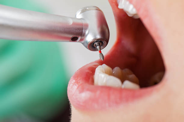 Best Lost Filling or Crown Replacement in Socastee, SC